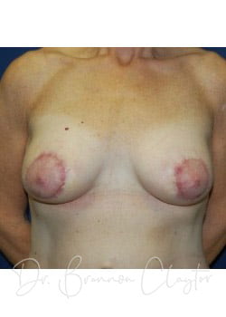 Breast Augmentation with Lift