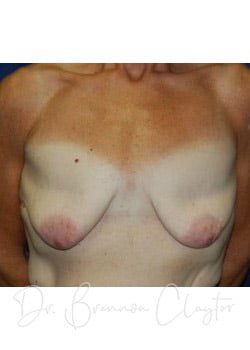 Breast Augmentation with Lift