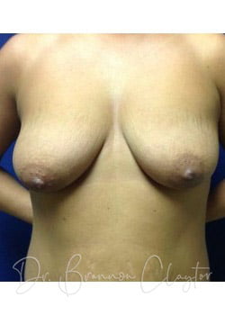 Breast Augmentation with Lift