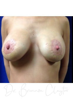 Breast Augmentation with Lift