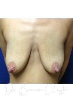 Breast Augmentation with Lift