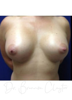 Breast Augmentation