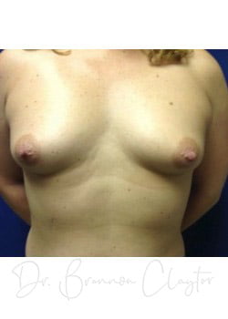 Breast Augmentation