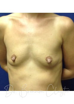 Breast Augmentation