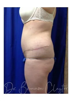 Abdominoplasty