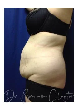 Abdominoplasty