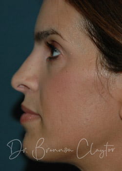 Rhinoplasty