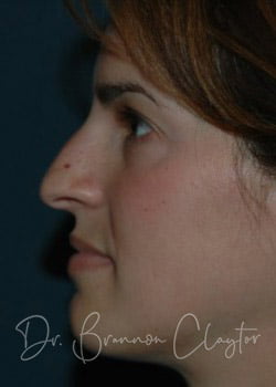 Rhinoplasty