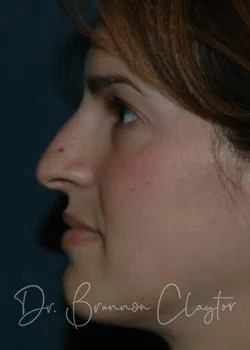 Rhinoplasty