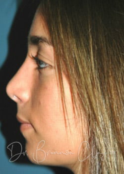 Rhinoplasty