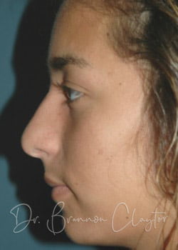 Rhinoplasty