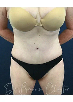 Tummy Tuck