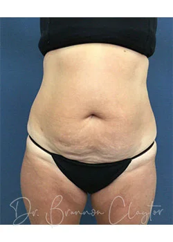 Tummy Tuck