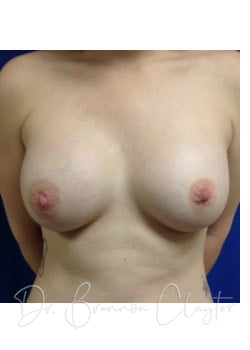 Breast Augmentation