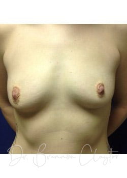 Breast Augmentation