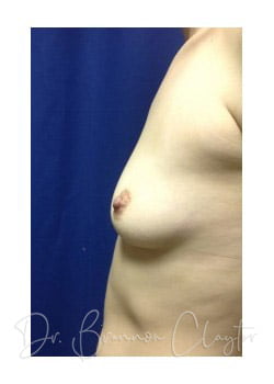 Breast Augmentation