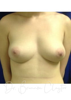 Breast Augmentation