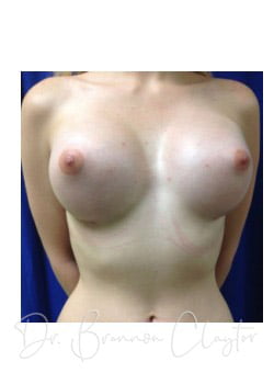 Breast Augmentation