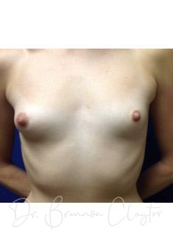 Breast Augmentation