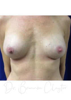 Breast Augmentation