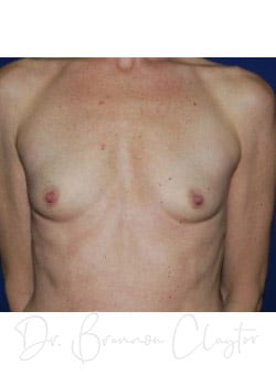 Breast Augmentation